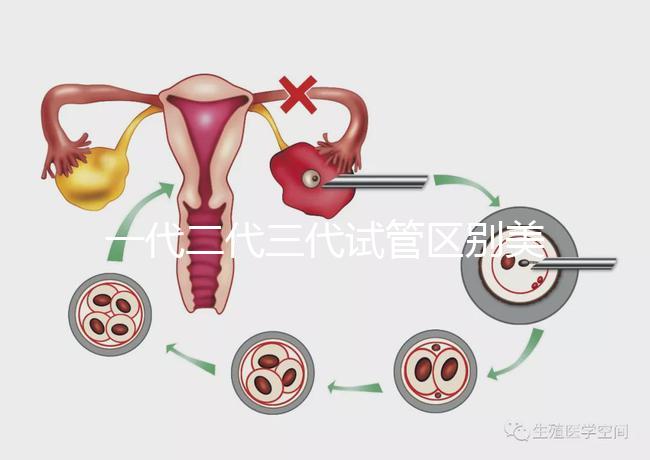 一代二代三代試管區(qū)別美琳達(dá)（一代二代三代試管區(qū)別及價格）