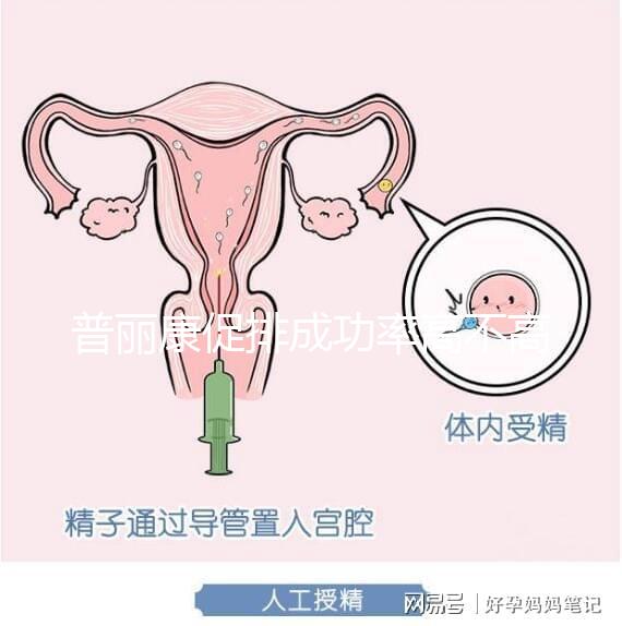 普麗康促排成功率高不高揭秘，能否取出卵泡的關鍵看…